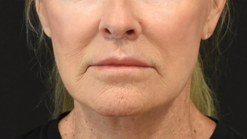 Extended Deep Plane Facelift Patient 14 Set 1 After