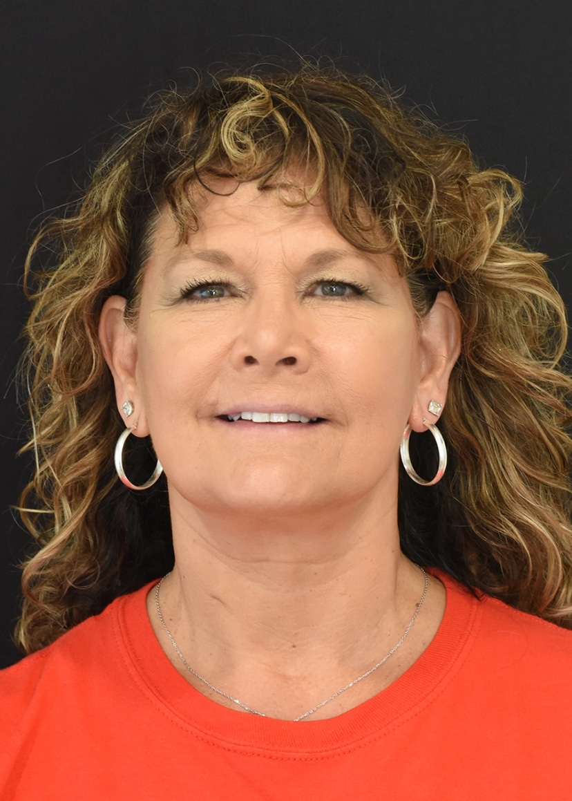 Extended Deep Plane Facelift Patient 4 Set 1 After